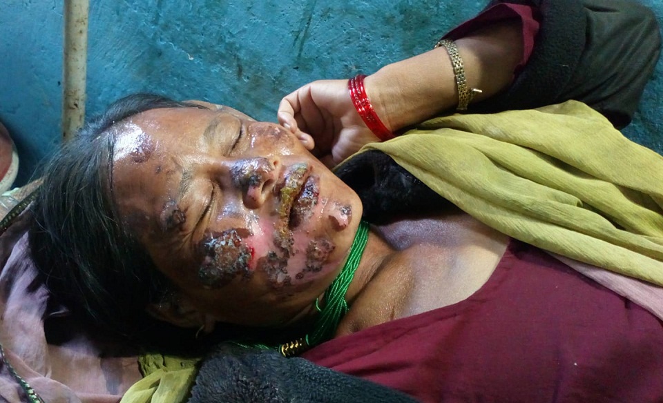 रोग निको पार्ने भन्दै पन्यू तताएर गाला र शरीरमा डाम्दै