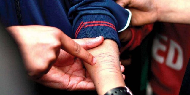 कम नम्बर ल्याउने प्रअका छोरासहित ३४ विद्यार्थीलाई ब्लेडले हात चिरेर निर्मम यातना