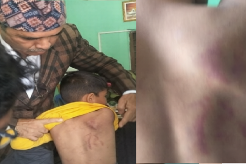 छ वर्षीय छोरालाई मरणासन्न हुनेगरी निर्घात कुटपिट गर्ने निर्दयी आमा झापामा पक्राउ
